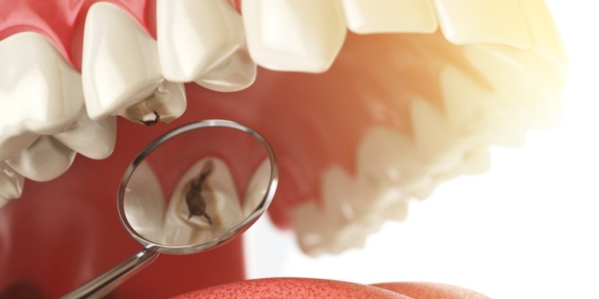 Expert Opinions: Are Dental Implants Worth the Investment?