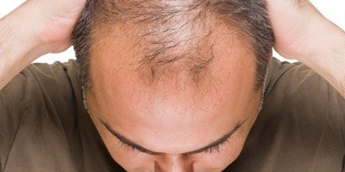 The Benefits of Finasteride for Hair Restoration
