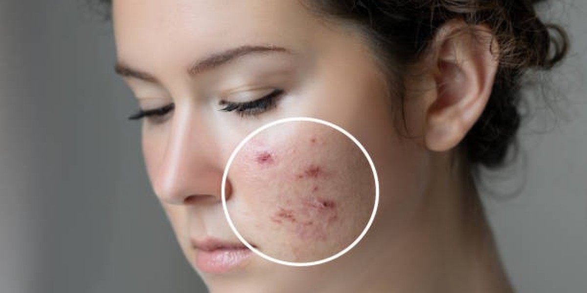 Rediscover Smooth Skin: Effective Acne Scar Treatments in Islamabad