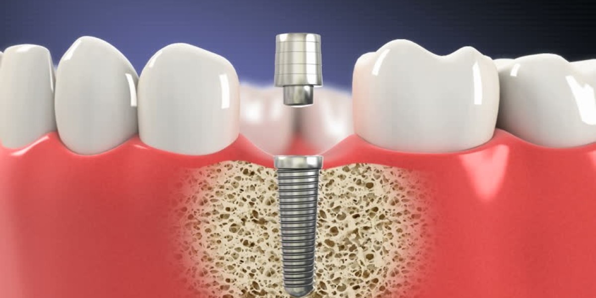 How Dental Implants Can Help You Achieve a Natural Look