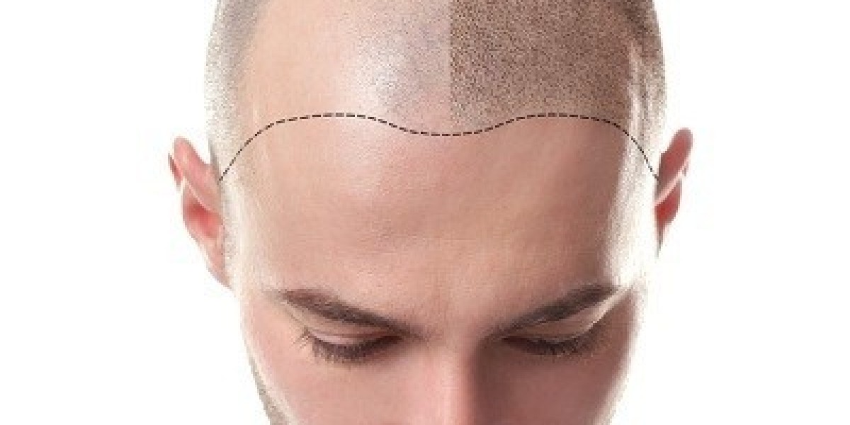 Is hair transplant permanent or temporary solution?