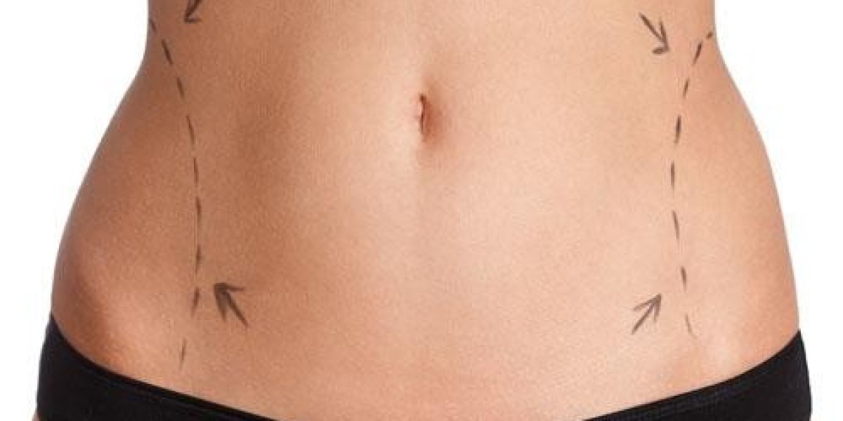 Body Perfection Made Easy: Liposuction in Dubai is Here!