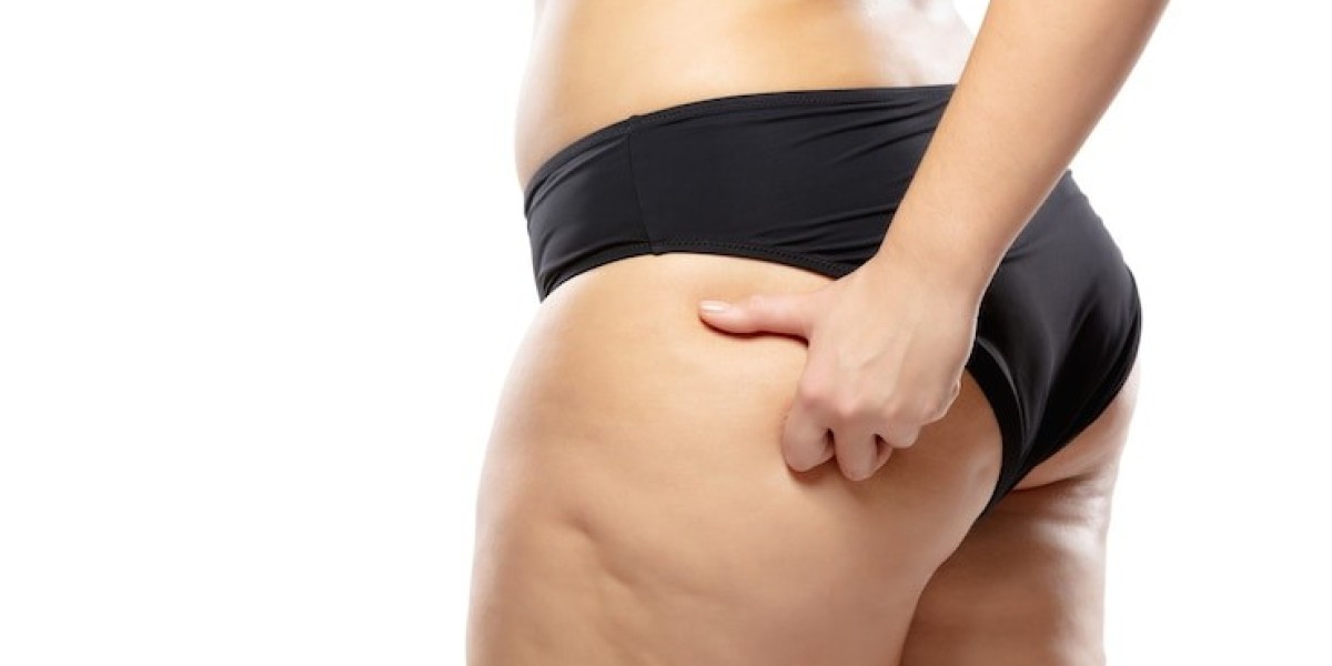 What deficiency causes cellulite?