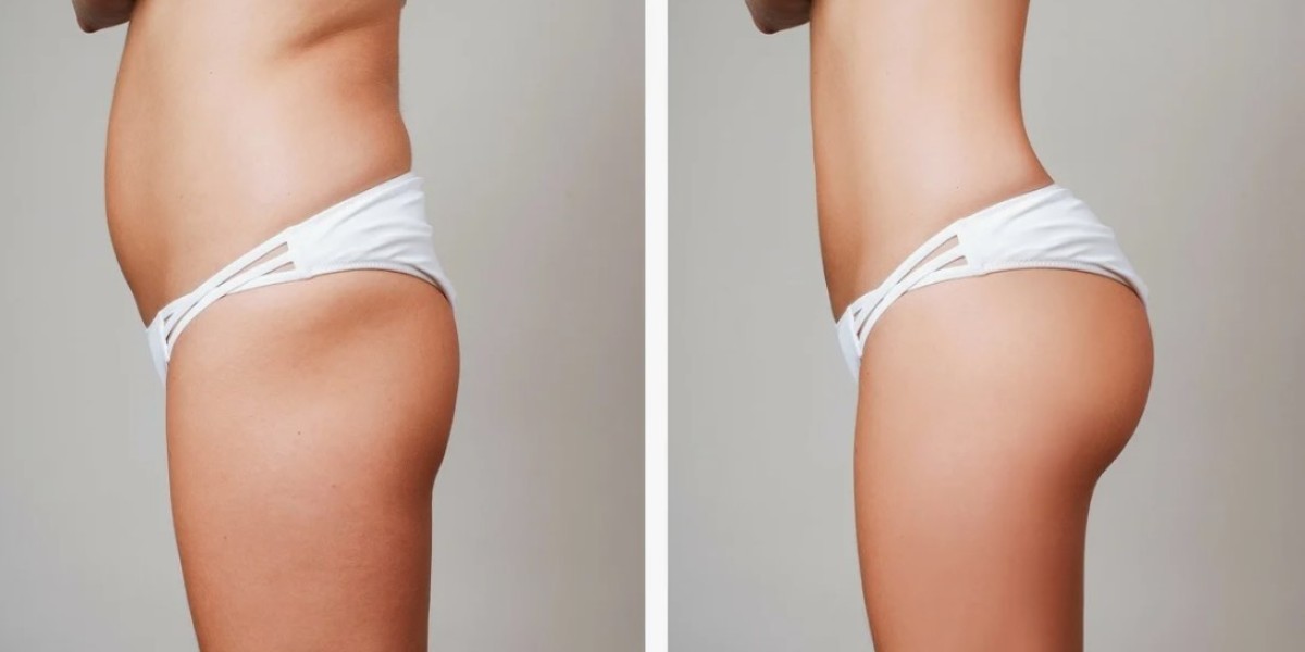 Top Cosmetic Centers for Brazilian Butt Lift in Riyadh