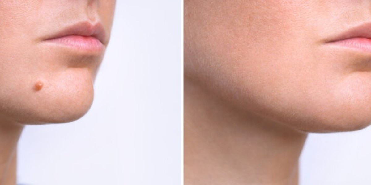 Are You a Candidate for Birthmark Removal in Riyadh?