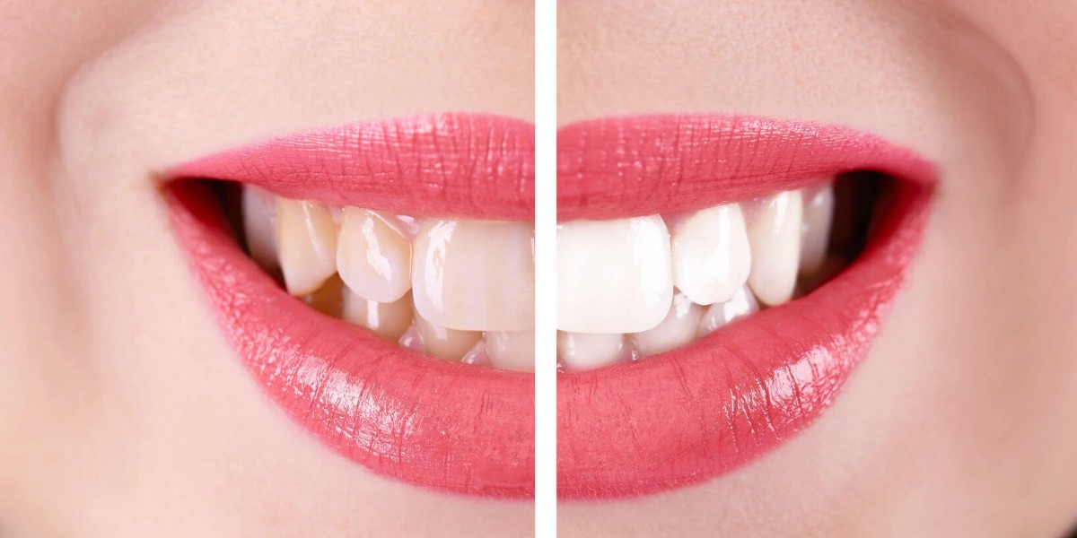 How Teeth Whitening Can Improve Your Smile’s Radiance?