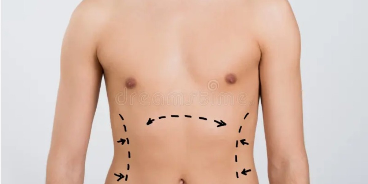 Liposuction Surgery in Riyadh Before and After Results