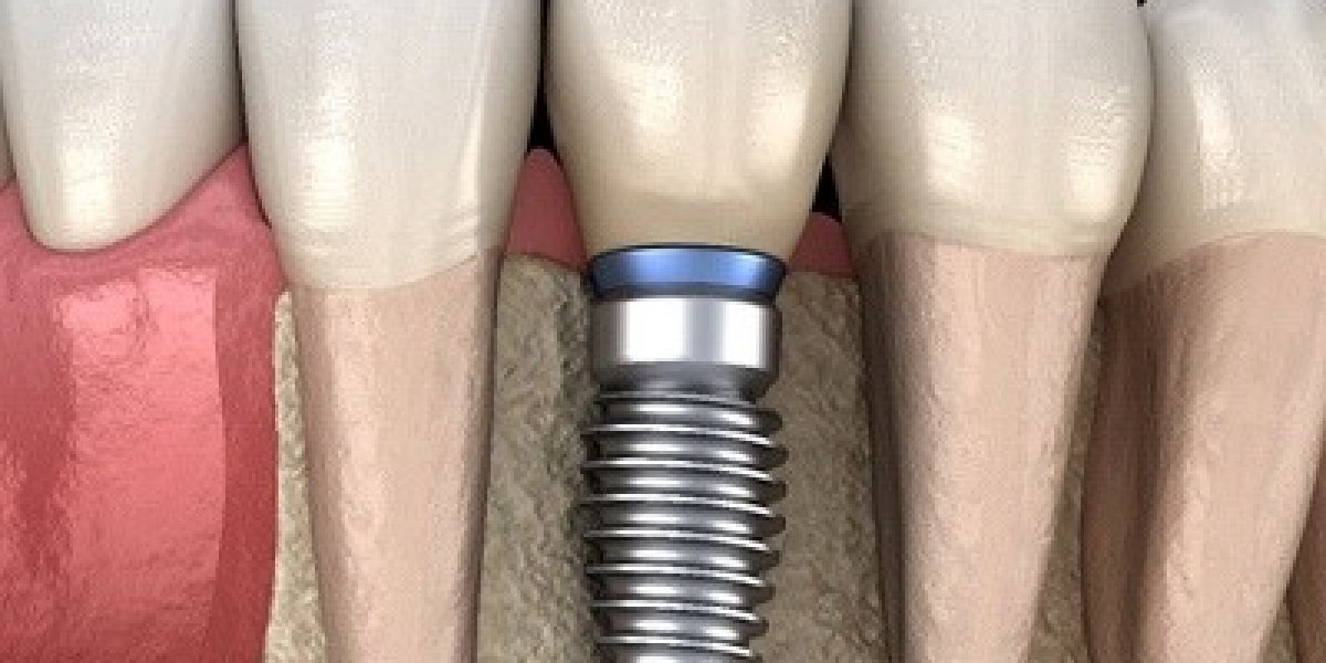 Is Dental Implants the Future of Tooth Replacement?