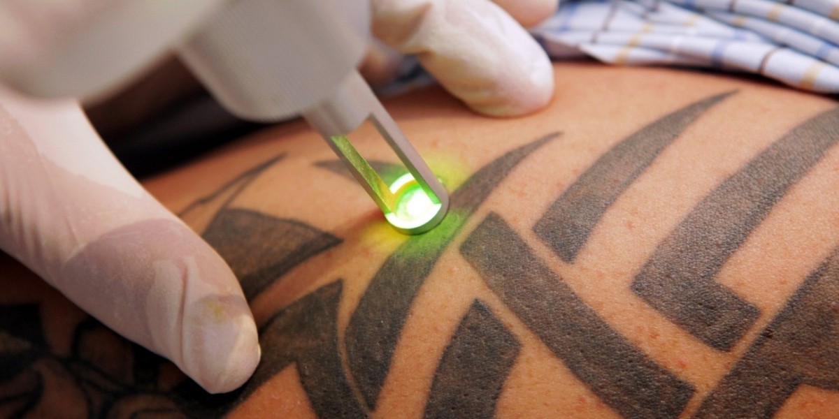 Factors Affecting Tattoo Removal Costs in Dubai