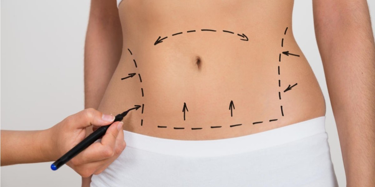 Top 10 Plastic Surgery Clinics in Riyadh for Abdominoplasty
