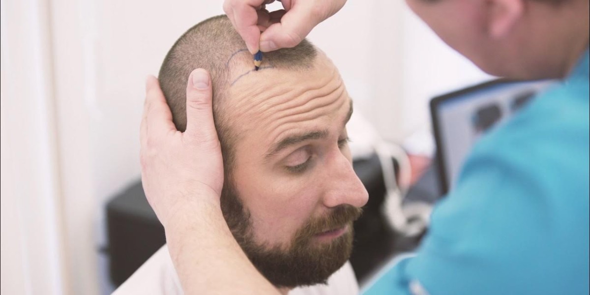Innovative Approaches to Hairline Design in Dubai