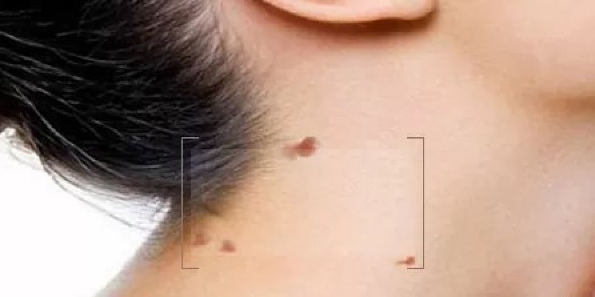 Your Path to Smooth Skin: Wart Removal in Dubai