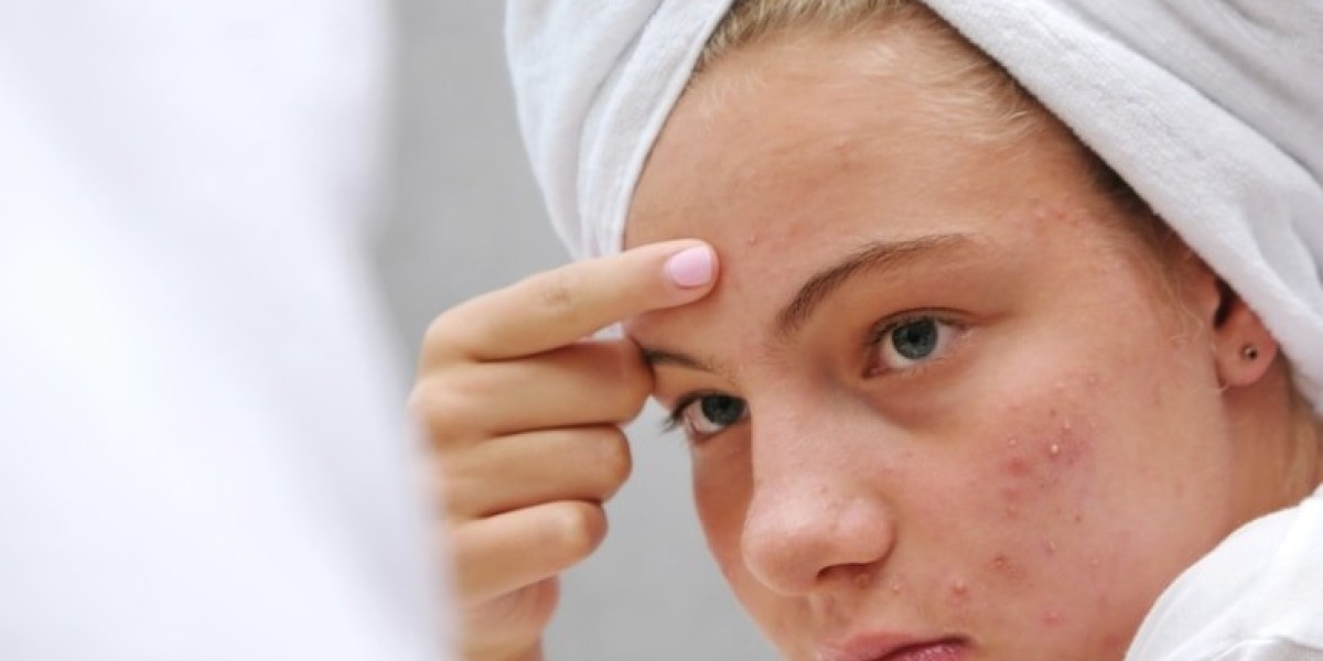 Is acne genetic?