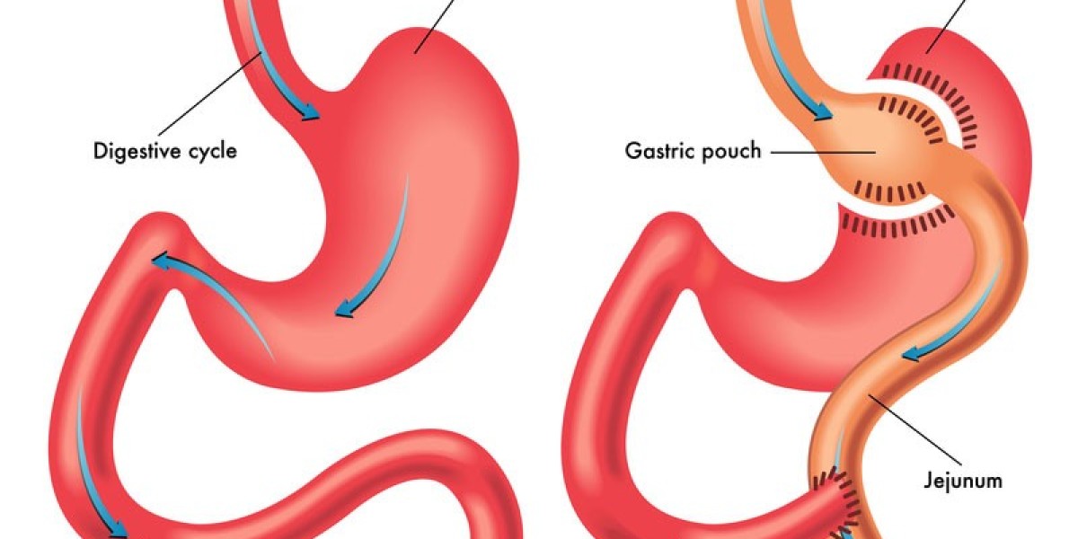 Laparoscopic Gastric Sleeve in Riyadh – Start Your Transformation