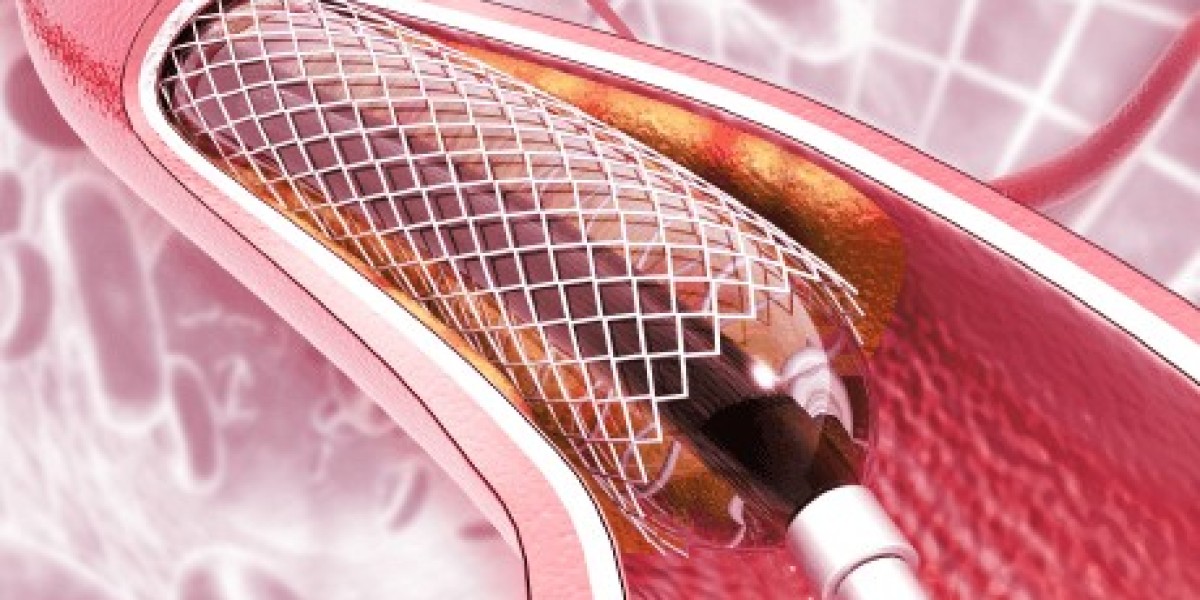 Angioplasty Balloons Market Key Drivers, Challenges, and Opportunities for Growth