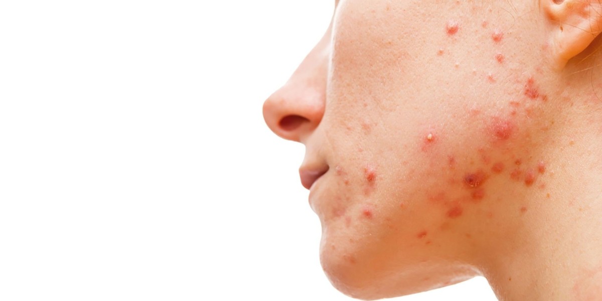 How Acne Treatment Helps Fight Bacteria and Prevent Future Pimples