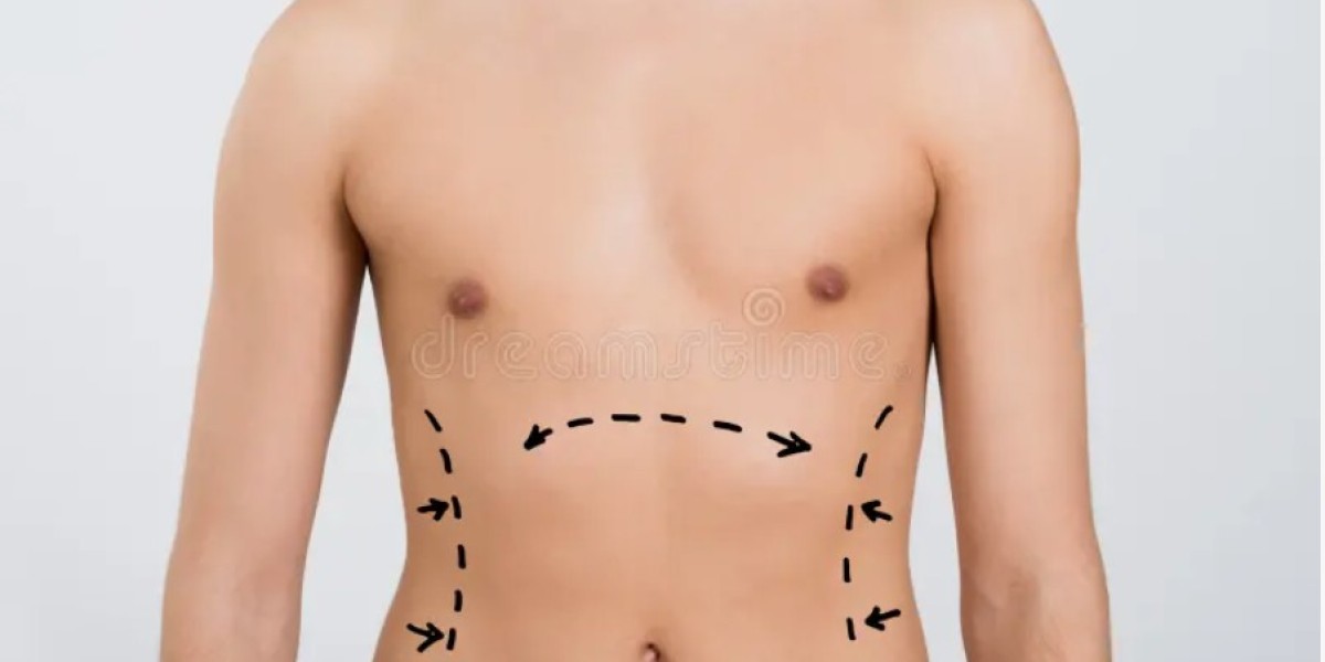 Male tummy tuck in Riyadh what men should know about the procedure