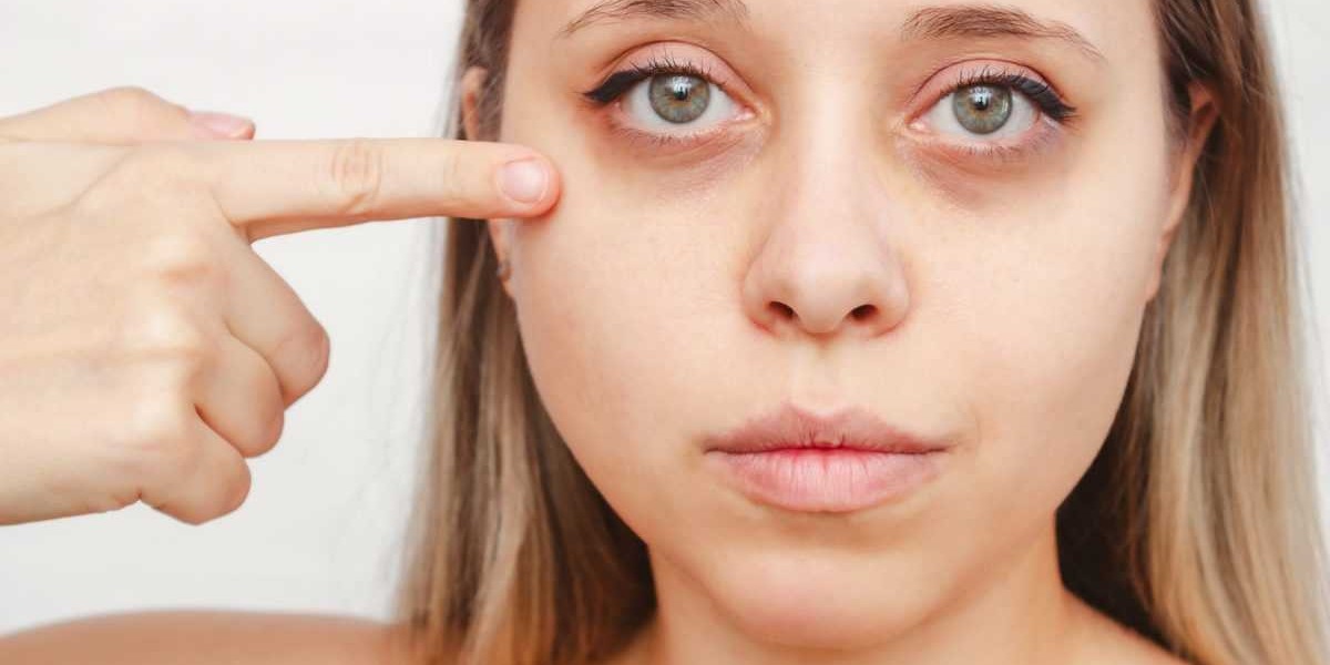 Microneedling for Dark Circles: Clinics in Riyadh