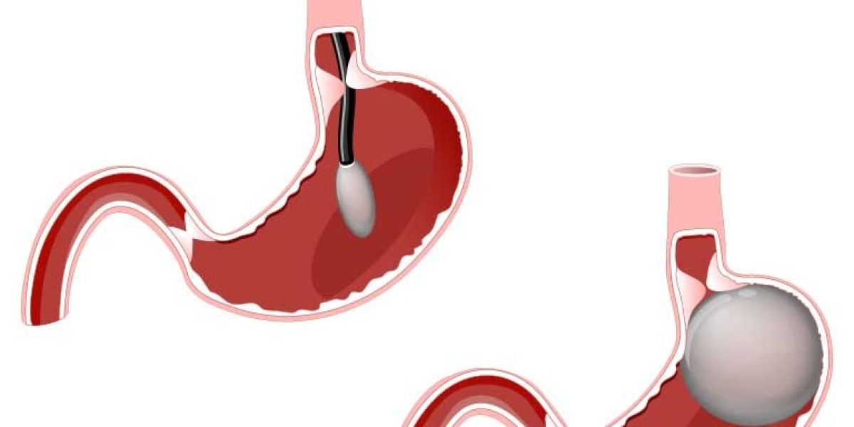 Allorion Gastric Balloon Riyadh – Affordable Weight Loss Plan