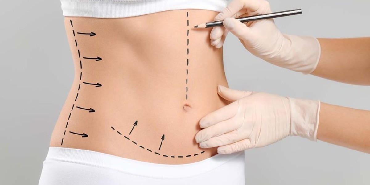 Tummy Tuck A Comprehensive Guide to the Surgical Process