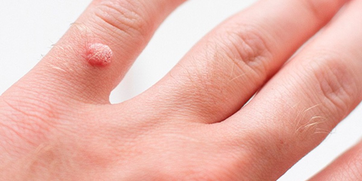 Laser Wart Removal: Is It Worth the Hype?