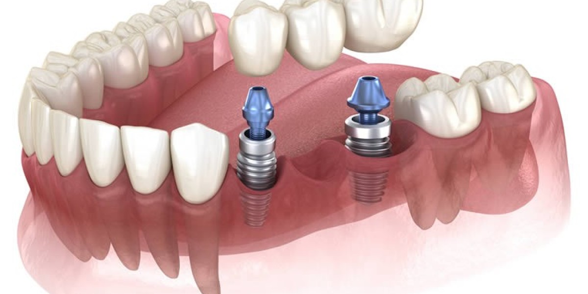 How Dental Implants Enhance Oral Function and Health