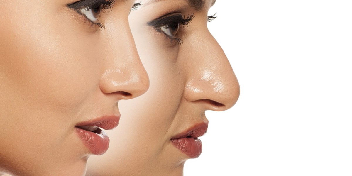 What to Expect During a Rhinoplasty Consultation in Dubai