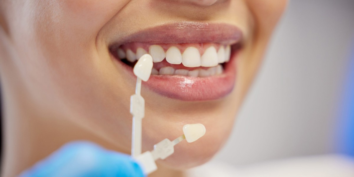 How Long Do Dental Veneers Last? Maintenance Tips for Longevity