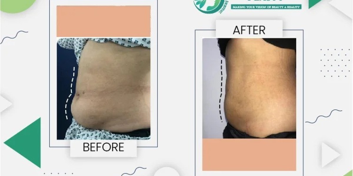 Liposuction in Lahore: Transform Your Body with Expert Care