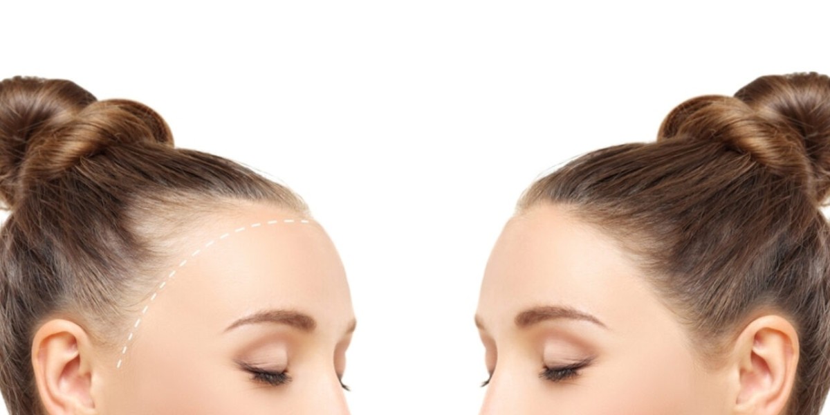 Finasteride: A Long-Term Solution for Hair Loss