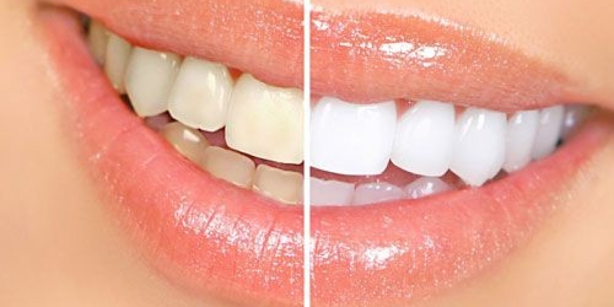 EMAX Crowns for Riyadh Residents: What You Should Expect