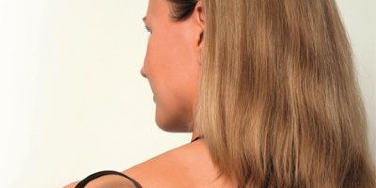 What Are the Best Methods for Birthmark Removal in Dubai?