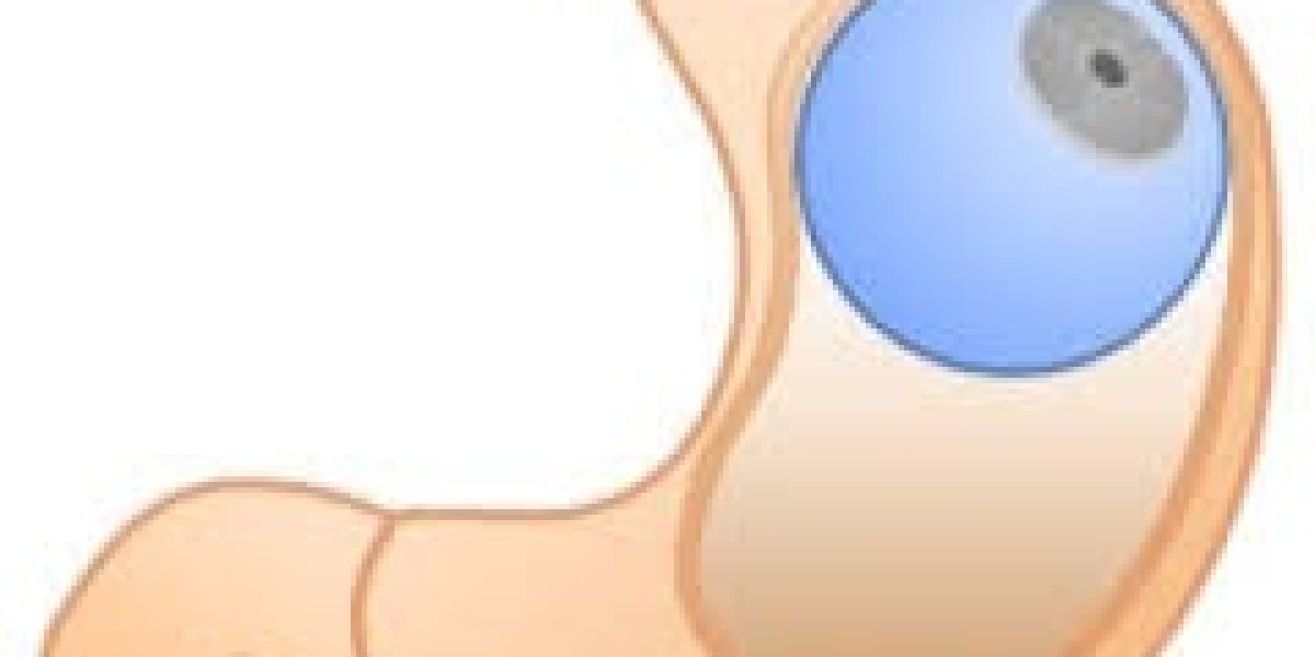 What Are the Pre-Procedure Requirements for Gastric Balloon Placement?