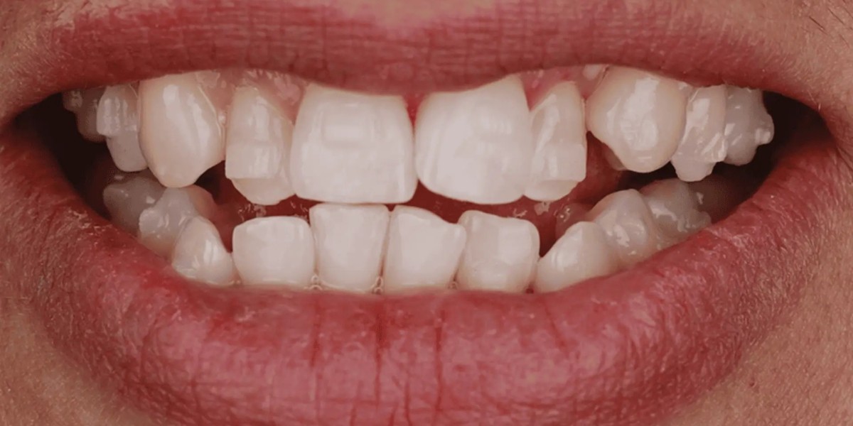 What Is the Cost Difference Between Invisalign and Clear Aligners in Dubai?