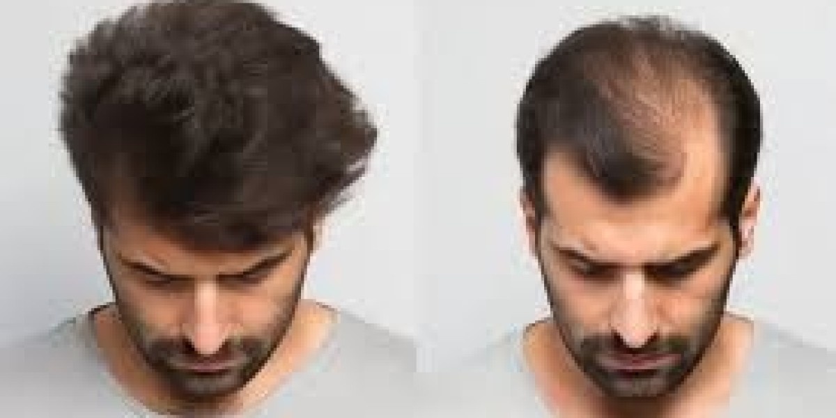 Boost Your Confidence with Riyadh’s Premier Hair Transplant Services