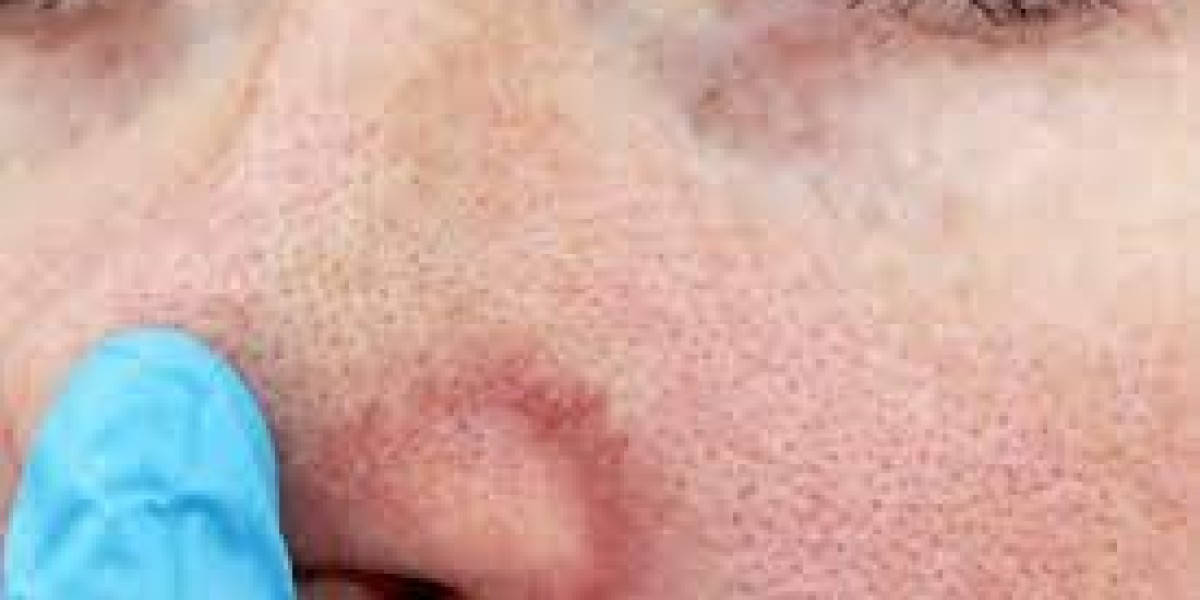 A Comprehensive Guide to Large Pores Treatment Expenses