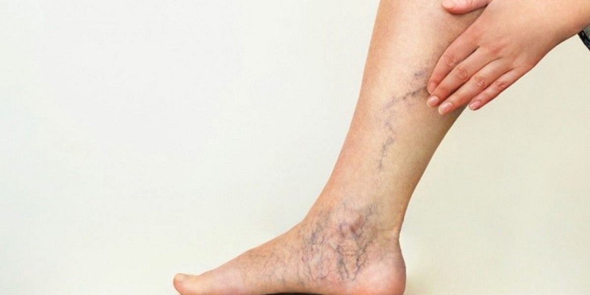How do you sleep with spider veins?