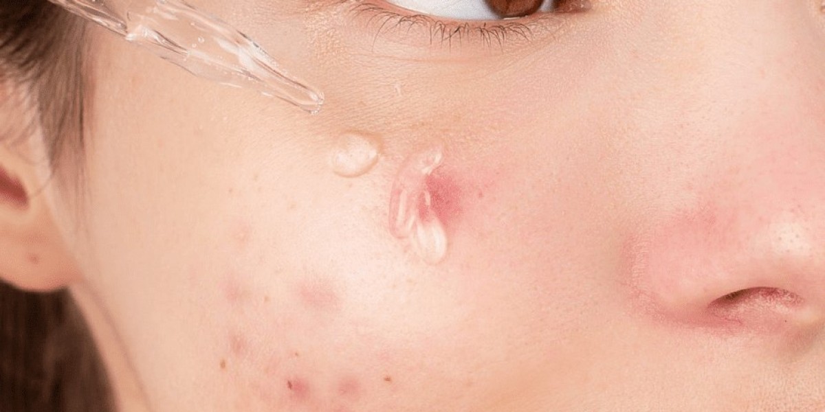 Anti-Acne Serum Market Role in Professional Skincare Treatments