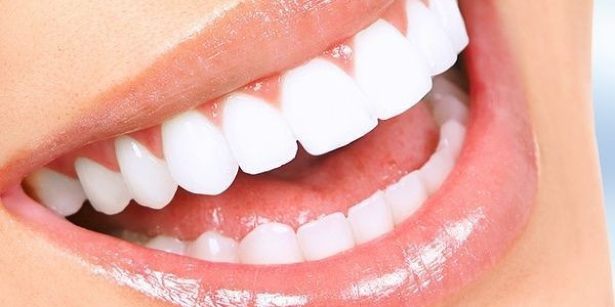 Hollywood Smile Price in Riyadh: Top Reasons to Choose It