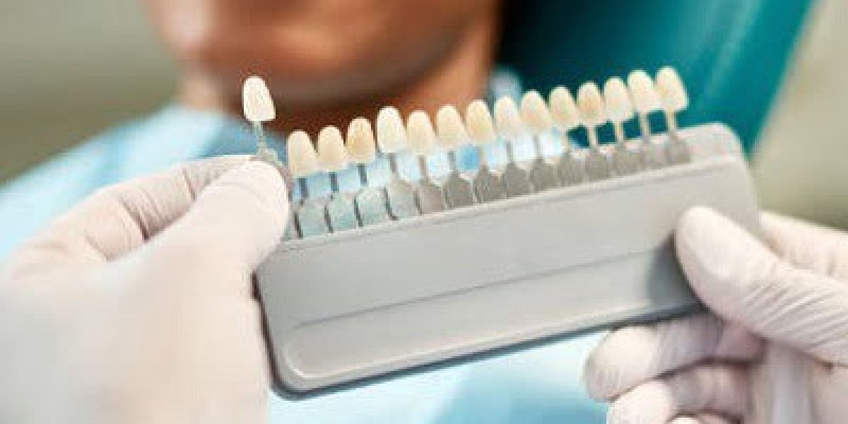 How Dental Veneers Can Change Your Smile: A Step-by-Step Guide