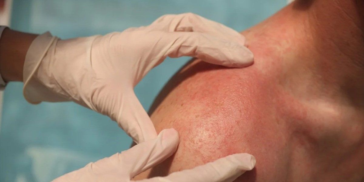Why the Best Dermatologist Is Your Go-To for Treating Skin Infections