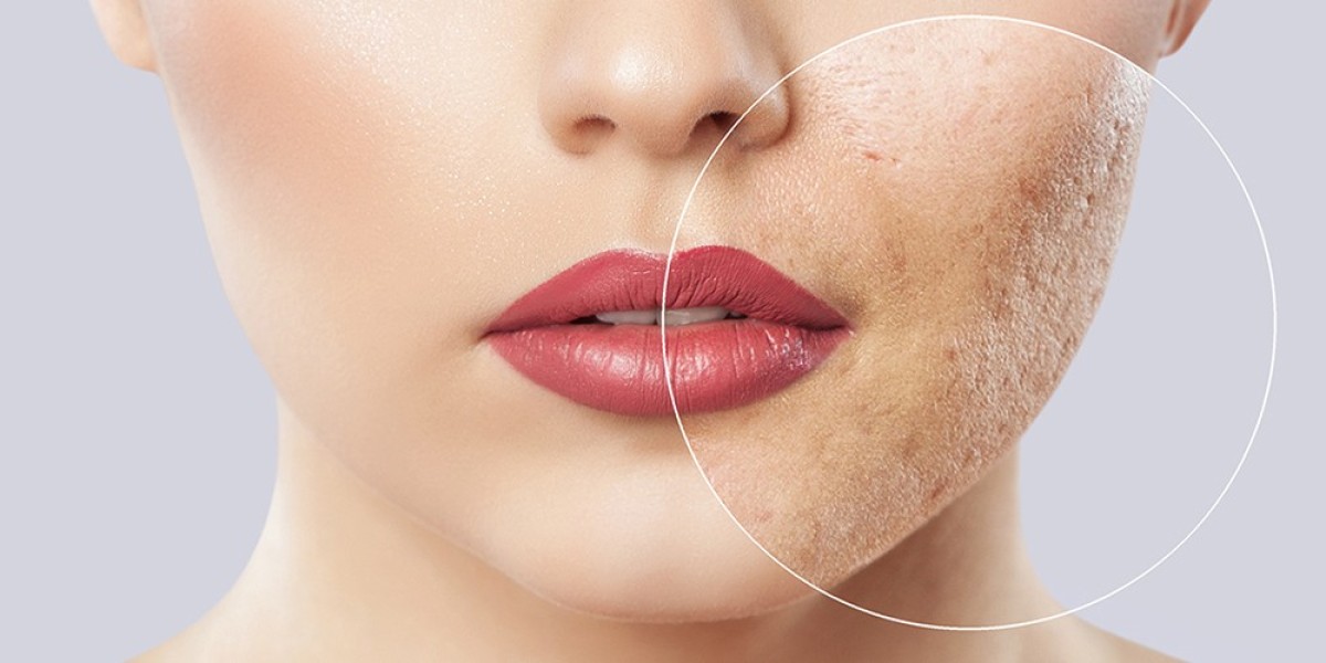 Skin Resurfacing Treatments for Acne Scars in Riyadh
