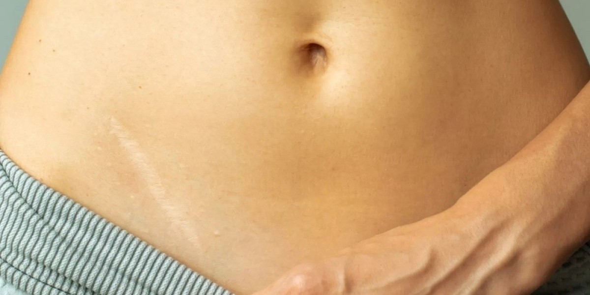 Permanent Scar Removal Solutions at Glamorous Clinic, Islamabad