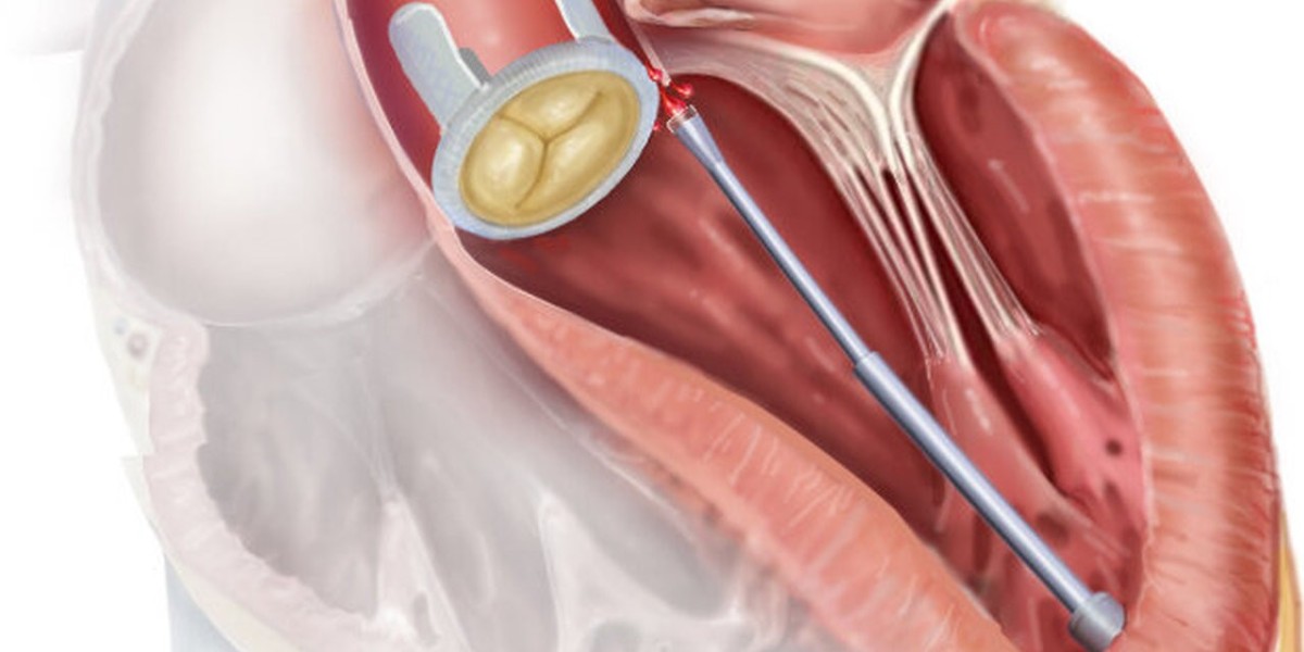 Prosthetic Heart Valves Market Potential: Opportunities in Untapped Segments and Emerging Economies