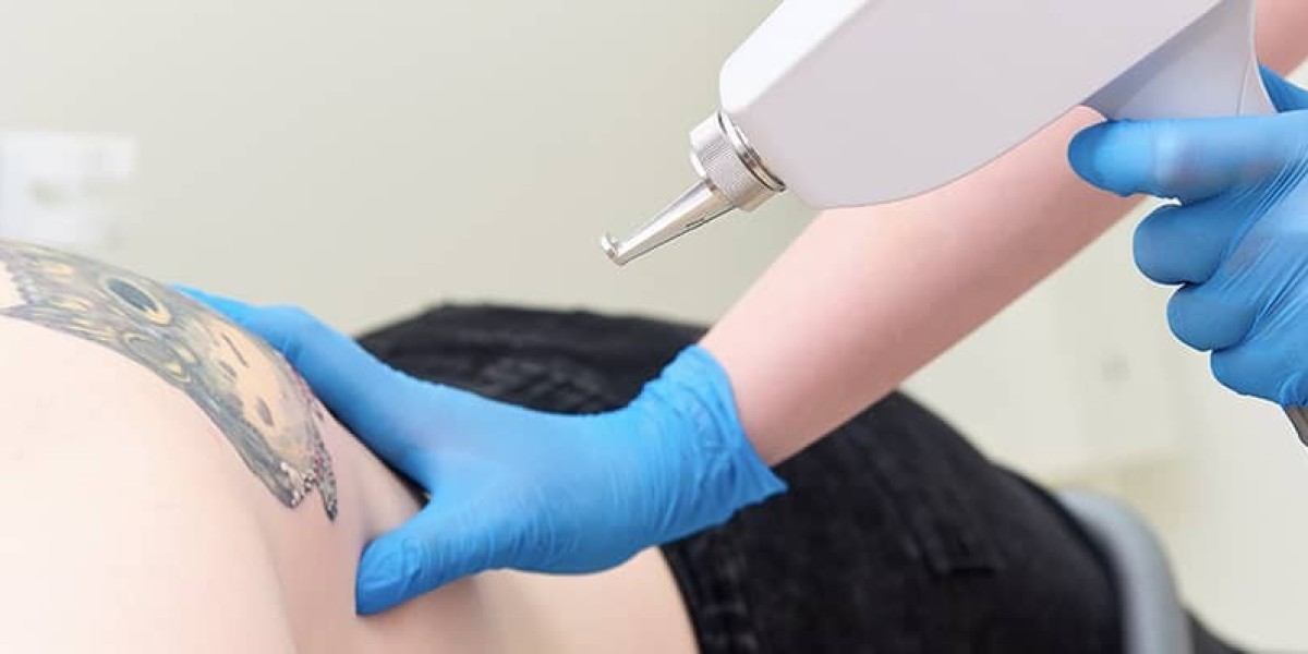 Are there any lifestyle factors that can affect the results of Laser Tattoo Removal Dubai?
