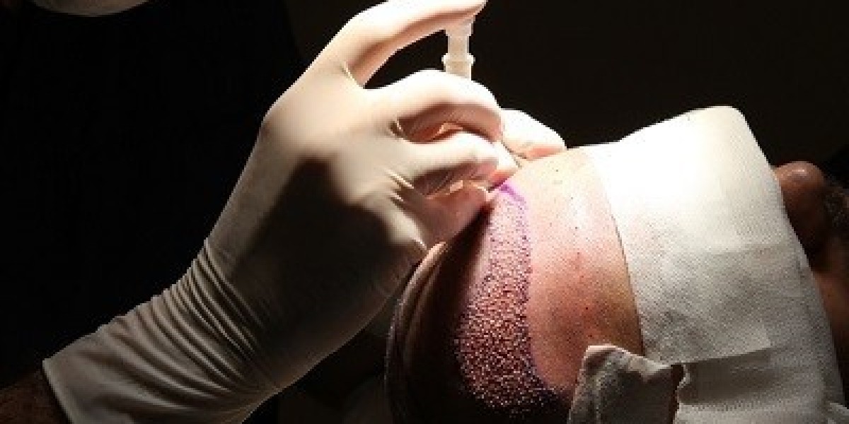 Can I Touch My Hair After a Hair Transplant?