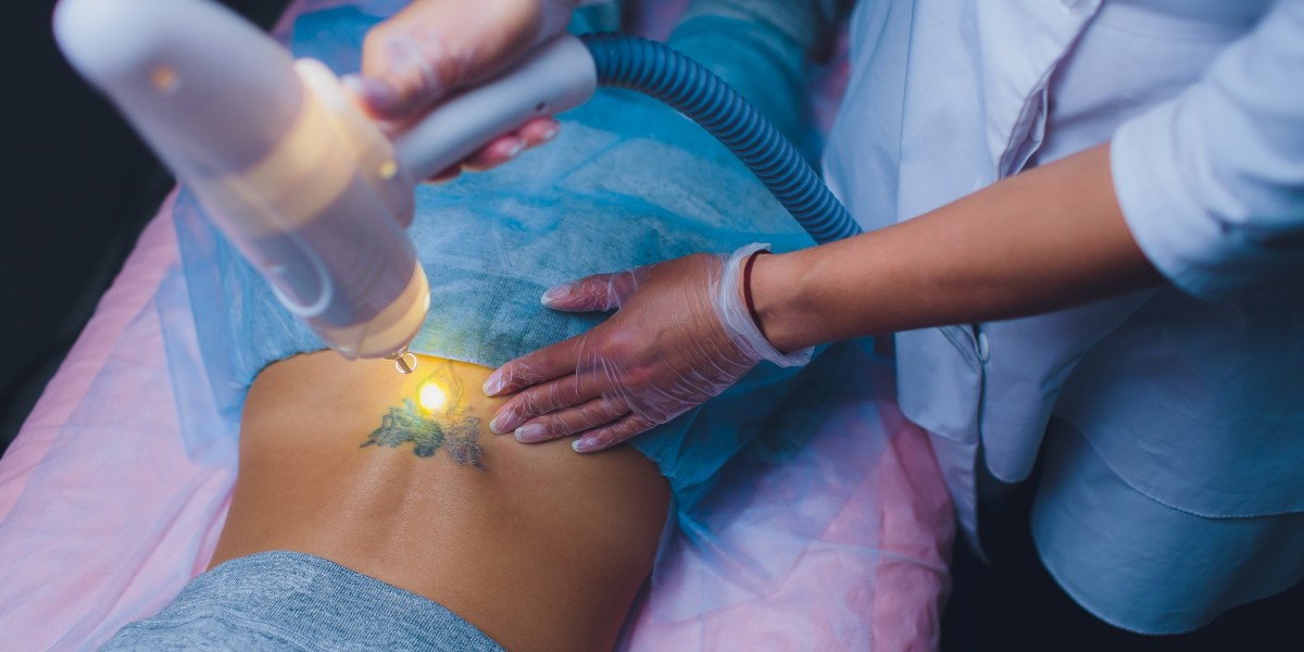 Breaking Up with Your laser Tattoo removal? Let Dubai’s Experts Help