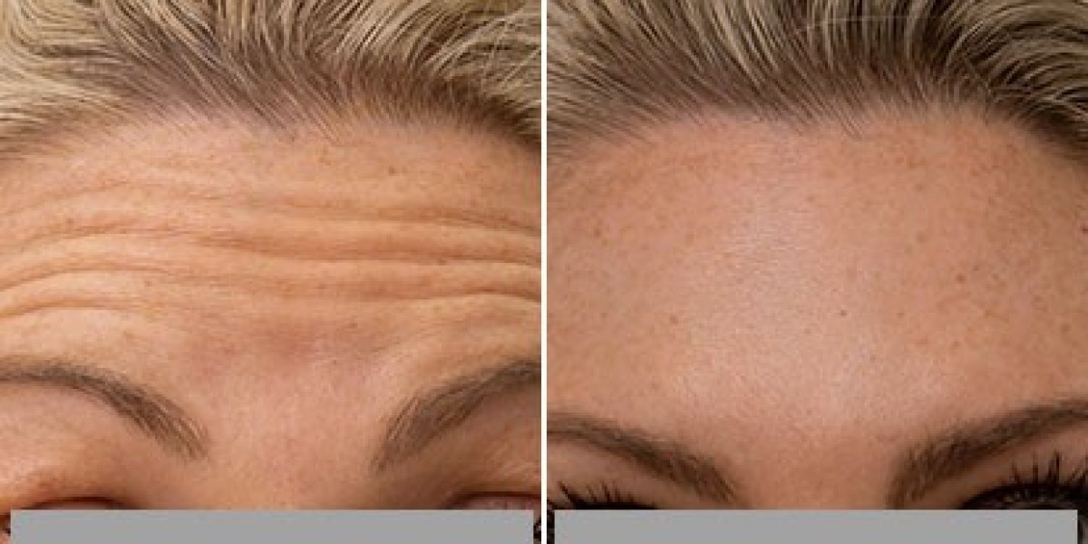 Forehead Lines Botox: A Complete Guide to Smoother, Younger-Looking Skin