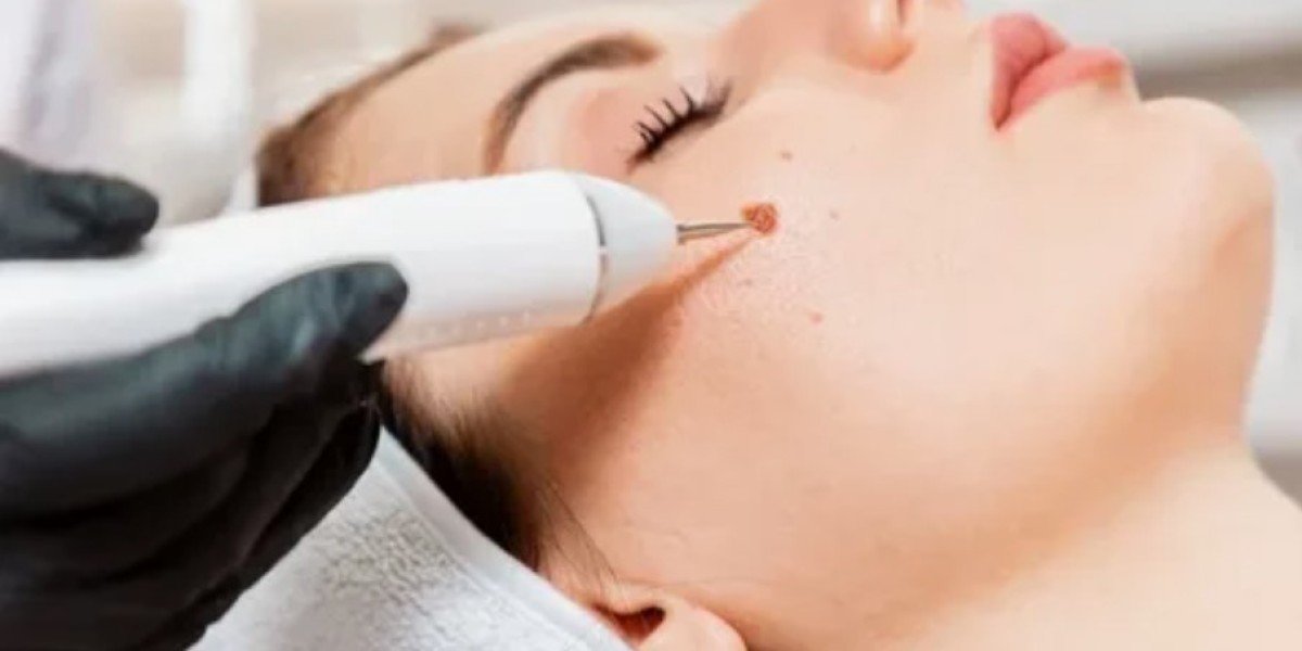 Finding the Best Dermatology Centers for Birthmark Removal in Riyadh