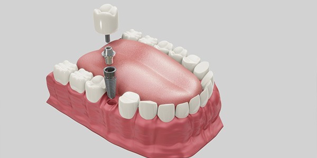 Is It Safe to Get Dental Implants with Heart Disease?